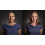 quanto custa peruca feminina para quimioterapia na Vila Sônia