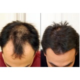 quanto custa perucas masculinas de cabelo humano em Interlagos